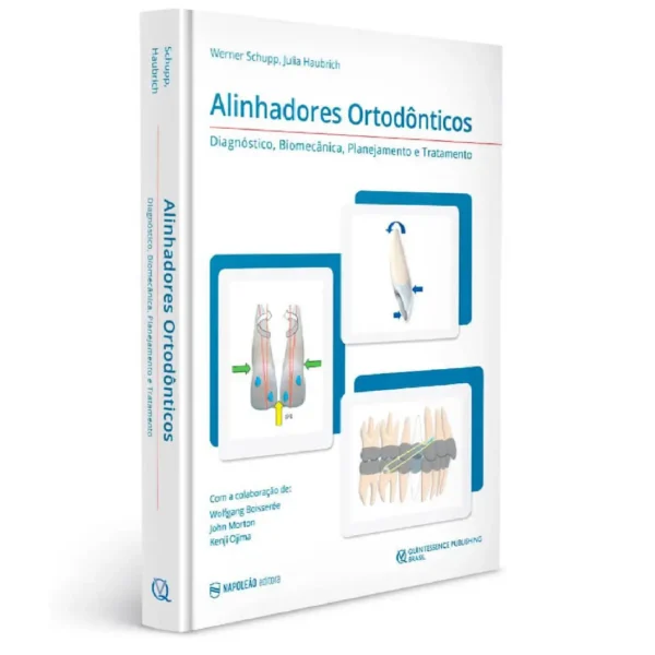 Alinhadores Ortodônticos – Diagnóstico, Biomecânica, Planejamento E Tratamento