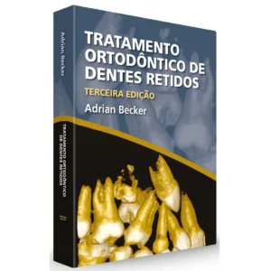 Tratamento Ortodôntico De Dentes Retidos