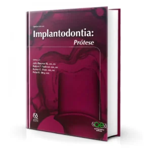 Fundamentos Em Implantodontia: Prótese