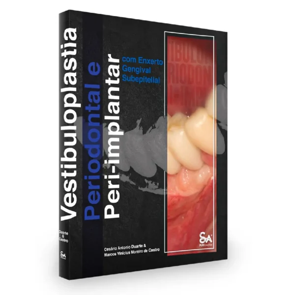 Vestibuloplastia Periodontal E Peri-Implantar Com Enxerto Gengival Subepitelial