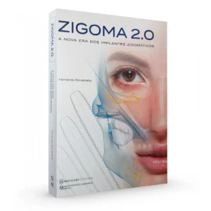 Zigoma 2.0 - A Nova Era Dos Implantes Zigomáticos