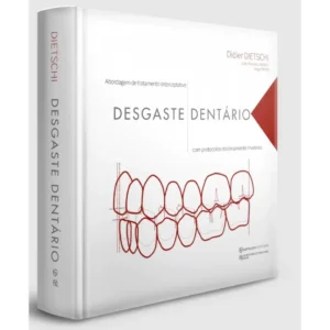 Desgaste Dentário - Abordagem De Tratamento Interceptativo Com Protocolos Minimamente Invasivos